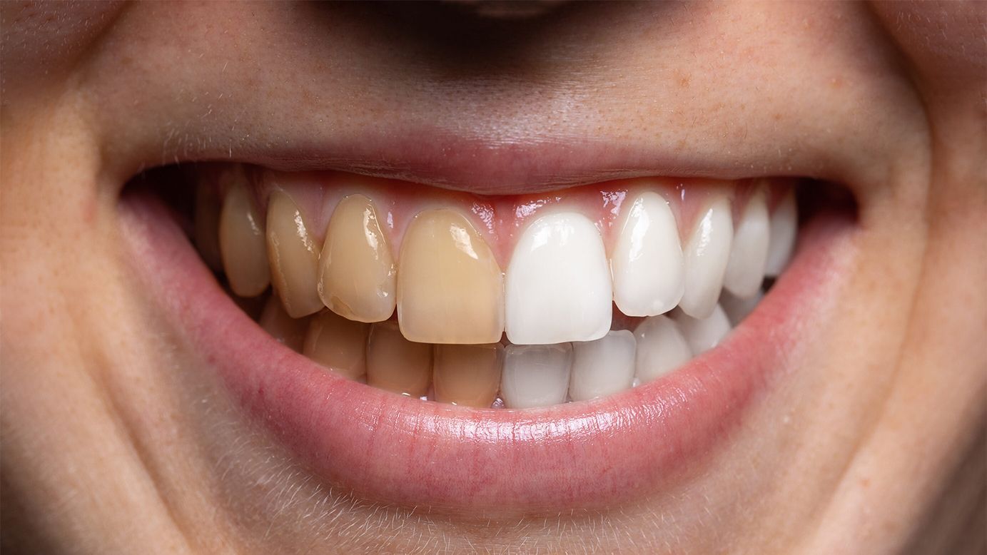 How To Remove Coffee Stains From Teeth?